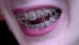 Seven rubber bands threaded through my braces lovingly.