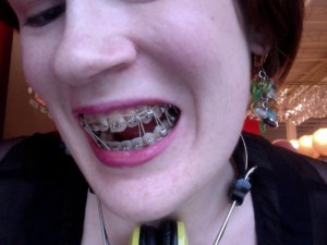 Seven Bands Tight Seven rubber bands threaded through my braces lovingly.