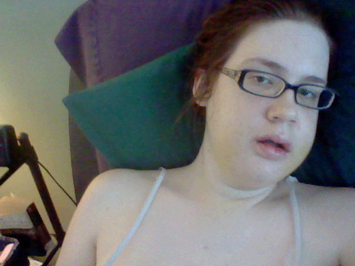 Recovering from jaw surgery Me recovering from jaw surgery, face swollen disproportionately, propped up sideway on pillows in bed.